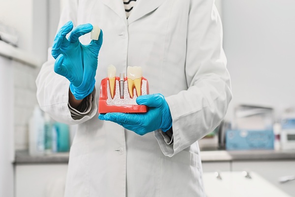 Dental Crown Placement: Front Vs Back Teeth